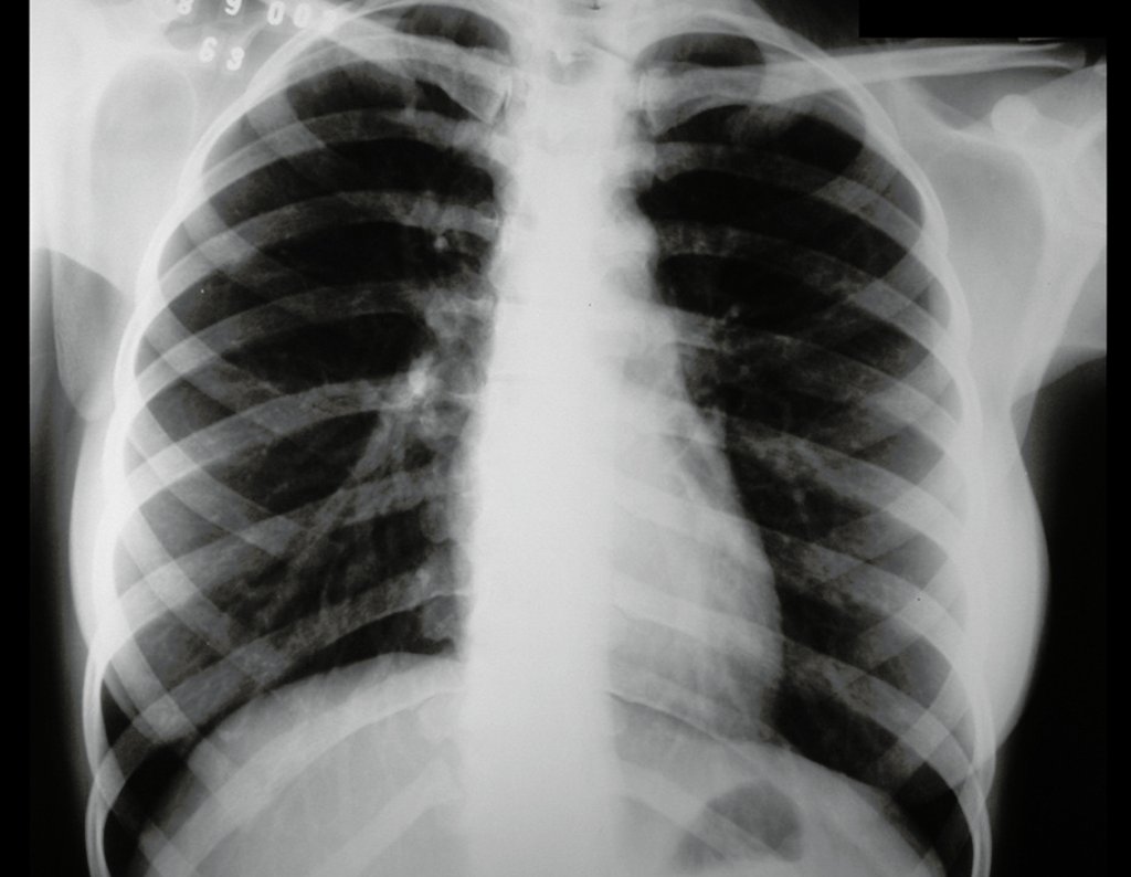 Figura 5: Radiografia do tórax, de 18/12/2002, sem alterações.