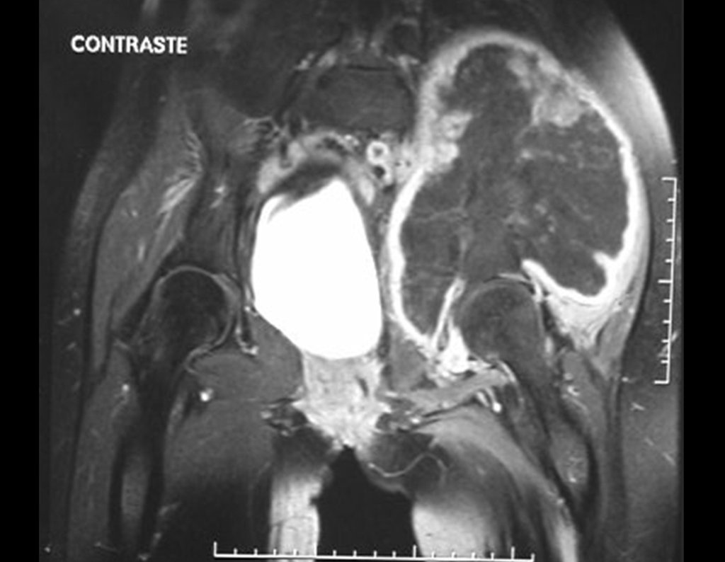 Figura 16: RM coronal T1, com saturação de gordura e contraste, evidenciando espessa área de captação (alto sinal) devido à capa de cartilagem neoplásica maligna, ao redor da lesão (com baixo sinal).