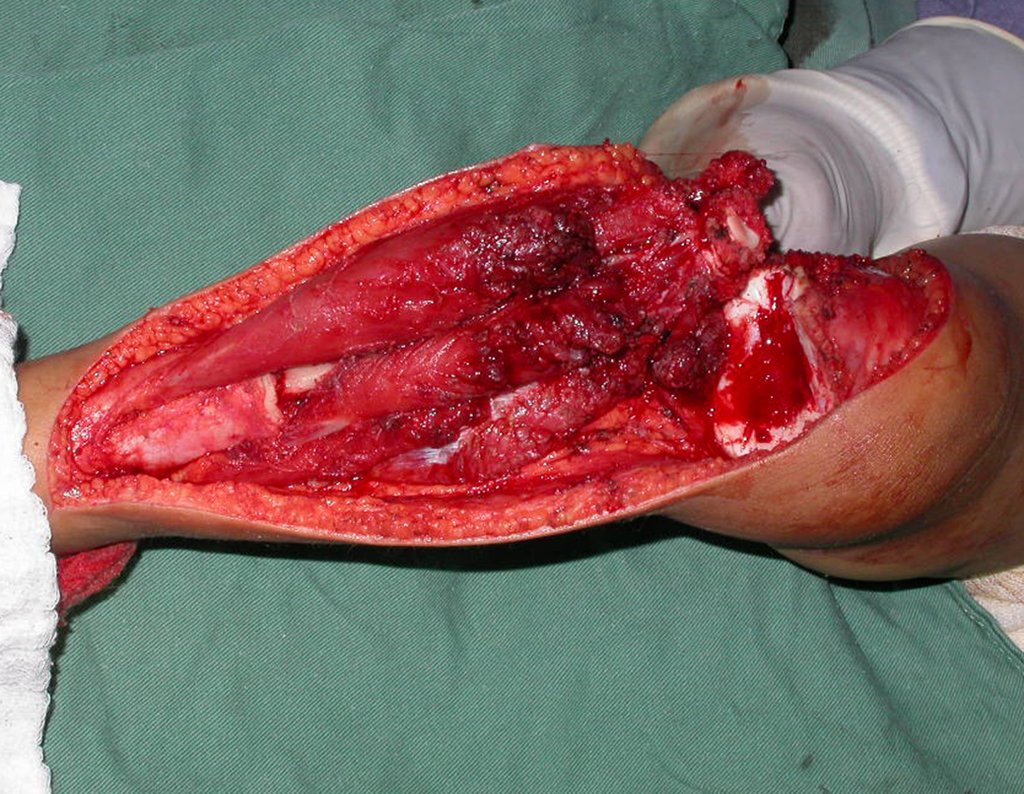 Figura 76: Fíbula encavilhada. Preparação para o posicionamento da epífise fibular, com a sua fise de crescimento, sob o a parte mais central da epífise tibial.