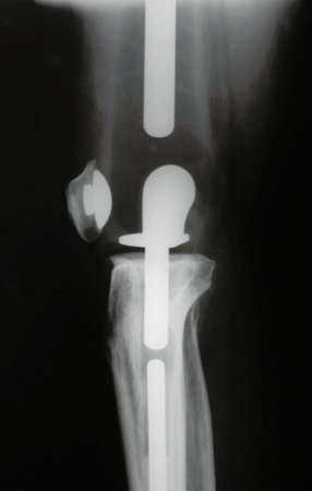 Figura 13: Radiografia de controle, perfil. (17/Out/2000).