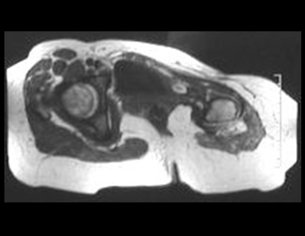 Figura 59: RM axial T1, após dois anos da cirurgia, sem sinais de recidiva.