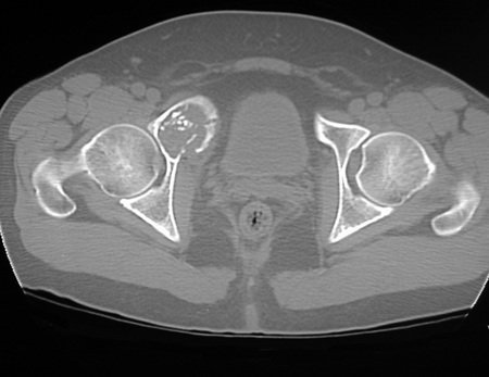 Figura 8: Corte tomográfico com densidade para tecidos moles. Observamos o comprometimento de parte do acetábulo e a evidente ruptura da cortical.