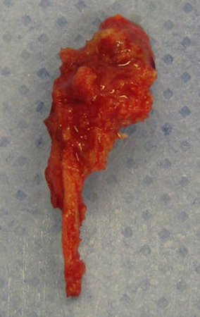 Figura 15: fragmento ósseo retirado da face lateral da tíbia para acessar o tumor subjacente.