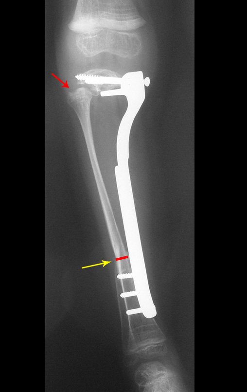 Figura 112: Radiografia pós operatório da perna direita, em 14/05/2007, frente, a seta vermelha assinala a sub-luxação da cabeça fibular. A seta amarela destaca a consolidação distal.