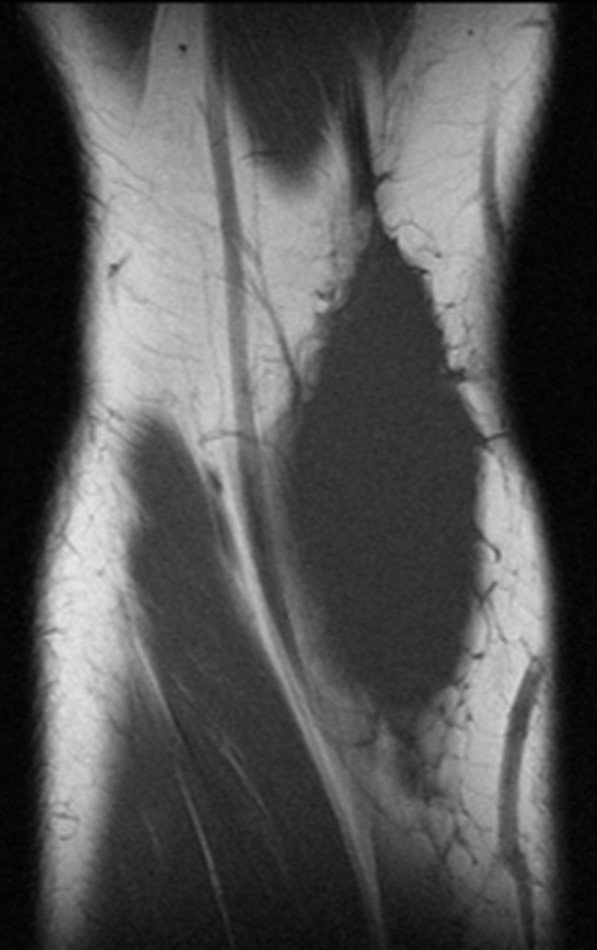 Figura 8: Ressonância magnética atual evidenciando imagem coronal, ponderada em T1, com lesão de baixo sinal.