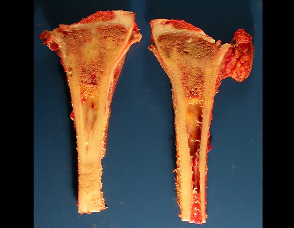 Figura 106: Peça ressecada e dividida em duas partes, para estudo anatomo patológico do gráu de necrose e da margem oncológica da ressecção. Em destaque o trajeto da biópsia ressecado em bloco com a lesão.