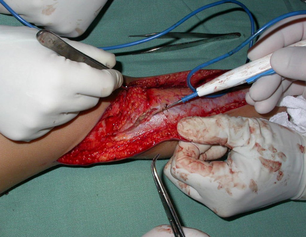 Figura 38: abertura do perimísio do tibial anterior proximalmente.