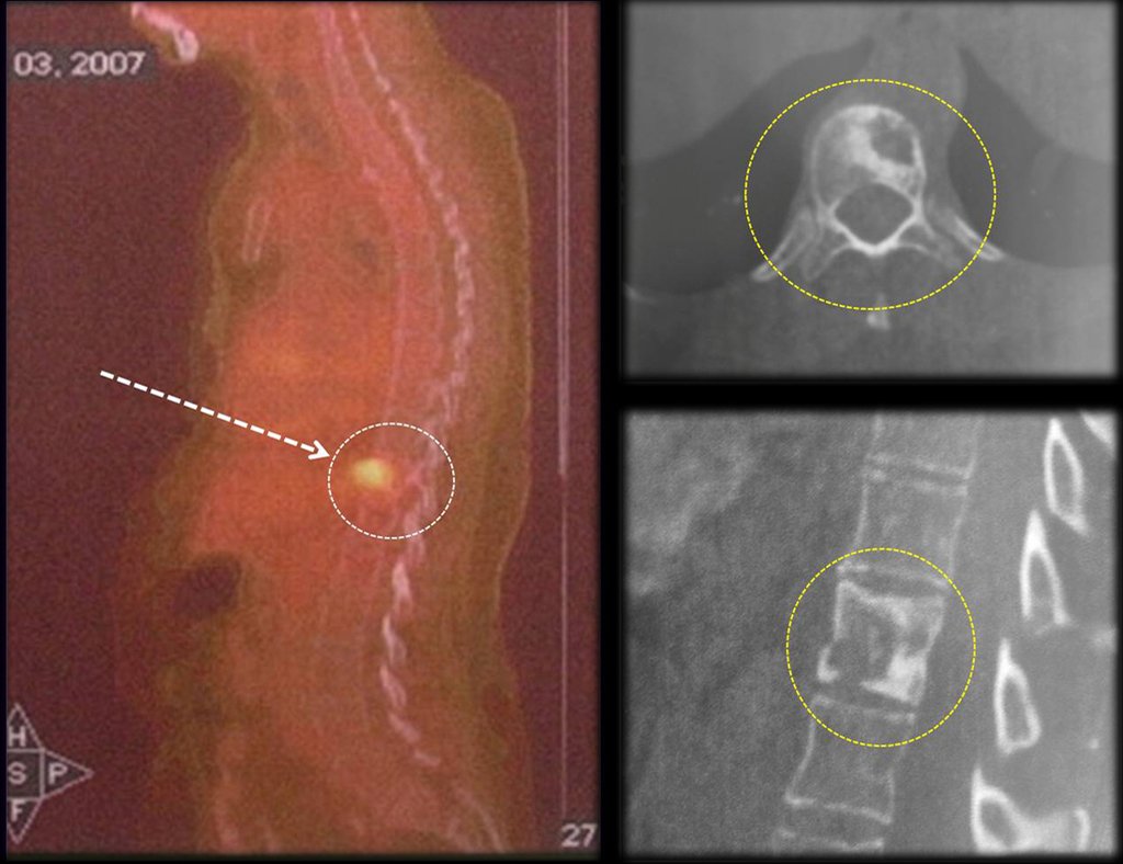 Figura 38: Imagem evidenciando a lesão na vértebra Toráxica T11. Figura 39: Visualização mais próxima da lesão na vértebra toráxica T11 e no retroperitoneo.