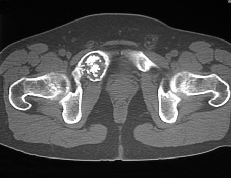 Figura 7: Corte tomográfico com densidade para osso. Lesão de rarefação óssea com insuflação e erosão da cortical, com evidentes focos de condensação que sugerem fortemente tratar-se de focos de calcificação.