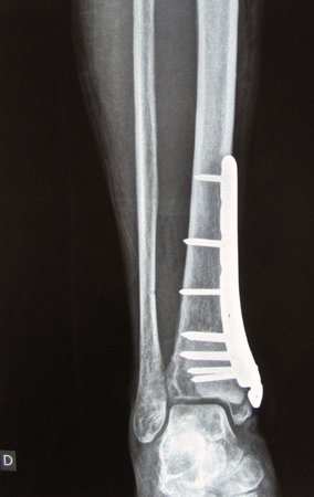 Figura 23: Rx de frente do tornozelo direito no pós-operatório imediato. Vemos a falha óssea produzida pela retirada do tumor quase totalmente preenchida pelo cimento. A coluna medial da tíbia foi refeita e estabilizada pelo implante colocado.