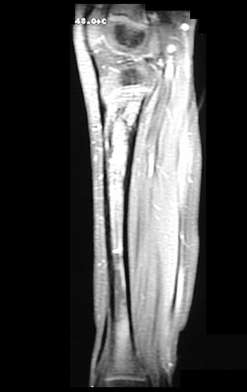 Figura 9: RM sag T1, com lesão meta-diafisária na tíbia.