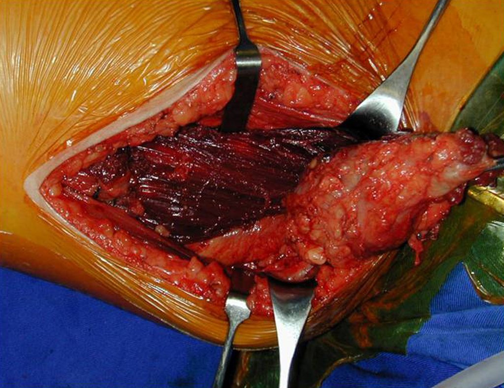 Figura 9: Ressecção de sarcoma de alto grau, da face medial da coxa, com margem ampla.