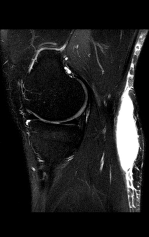 Figura 13: Ressonância magnética atual evidenciando imagem coronal ponderada em T1, com supressão de gordura, com lesão de alto sinal entre o plano celular subcutâneo e a fáscia muscular.