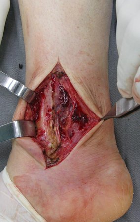 Figura 14: Incisão. A dissecção em planos profundos no tornozelo se restringe a fáscia e ao início do ventre muscular do tibial posterior. Logo nos deparamos com a tíbia e a lesão tumoral na sua região posterior. Note que é difícil definir o plano de clivagem entre o tumor com os tecidos adjacentes.