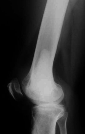 Figura 4: Radiografia, em perfil, com rarefação anterior, indicando a presença de tumor. Devemos assinalar que isto não se trata de recidiva e sim neoplasia que continuou na cavidade.