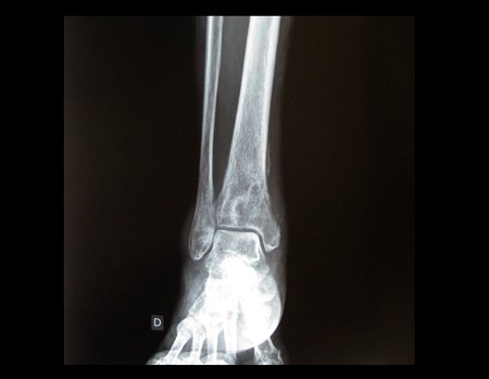 Figura 11: Rx de frente do tornozelo direito realizada um mês após o primeiro exame. Lesão nitidamente mais agressiva quando comparada a radiografia inicial. Apresenta destruição da parede medial da tíbia e reação periosteal. Os limites da lesão já não estão nítidos como anteriormente e a reação esclerótica não delimita mais o tumor.