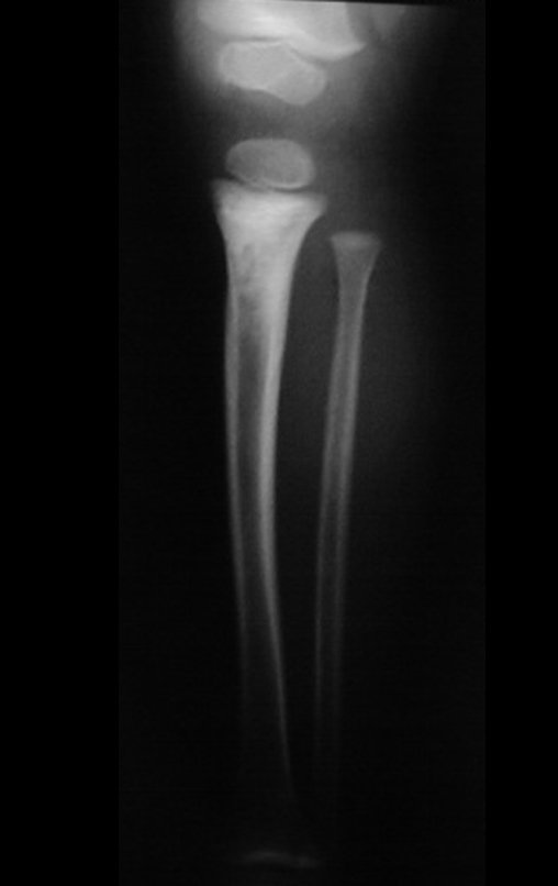 Figura 2: Radiografia da perna em perfil, lesão condensante na metáfise proximal da tíbia.