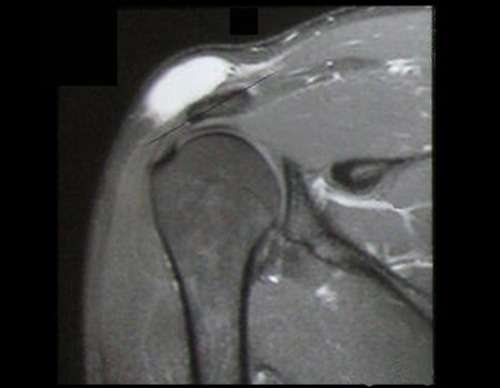 Figura 9: Rm coronal com captação de contraste, em T1 com supressão de gordura e gadolínio.