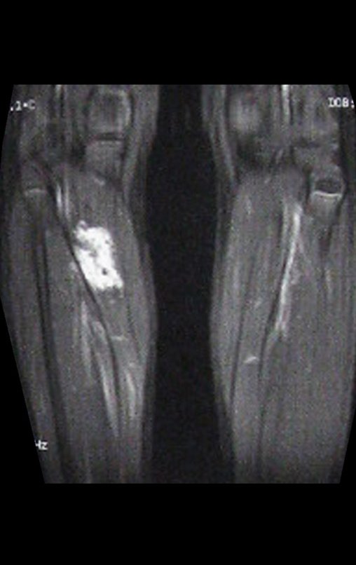 Figura 8: Rm coronal T1, com supressão de gordura e contraste Gadolíneo. A lesão apresenta alto sinal, o que sugere vascularização interna do tumor.