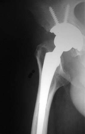 Figura 3: Radiografia da pelve direita, após reconstrução com prótese convencional. O paciente foi tratado como condroma, inadequadamente.