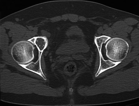 Figura 3: Corte de tomografia evidenciando a lesão, com comprometimento do ramo íleo púbico direito e parte da parede do acetábulo.