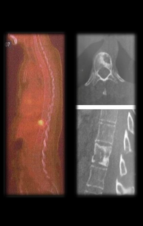 Figura 48: Pet-Cet, lesão metastática na vertebra T11, em 2007.