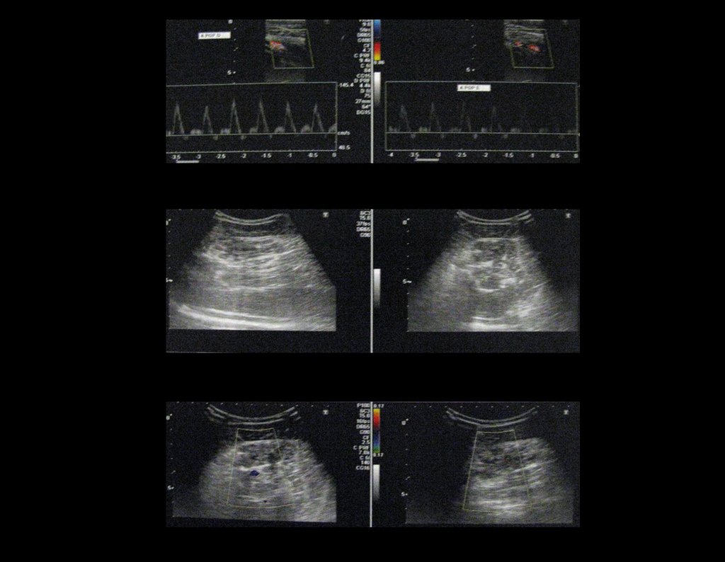 Figura 3: lesão hipovascular ao doppler, com prováveis flebólitos, localizada na porção proximal e medial do ventre muscular solear, sugestiva de hemangioma.