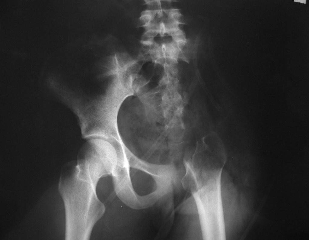 Figura 36: Radiografia do pós-operatório imediato, após a ressecção completa da hemipelve esquerda, juntamente com o colo femoral e o complexo capsulo-ligamentar da articulação do quadril esquerdo.