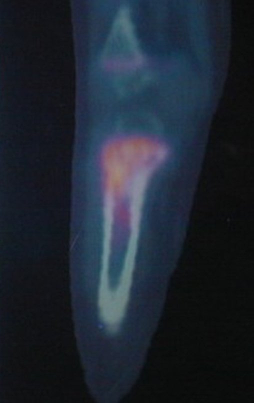 Figura 6: PET-CT, evidenciando o local da lesão.