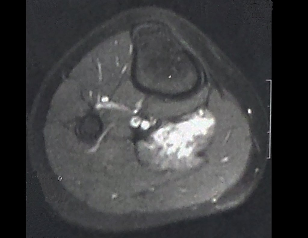 Figura 11: Rm axial T1 com contraste, lesão apresentando intenso realce, sugerindo que o tumor é altamente vascularizado.