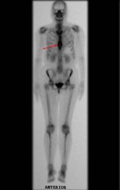 Figura 19: A cintilografia apresenta intensa captação na metade inferior do Esteno.