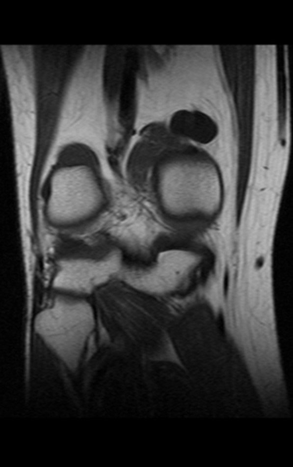 Figura 2: Ressonância magnética realizada um ano antes da queixa atual. Imagem coronal, ponderada em T1, evidenciando lesão de baixo sinal na região posterior do joelho direito.