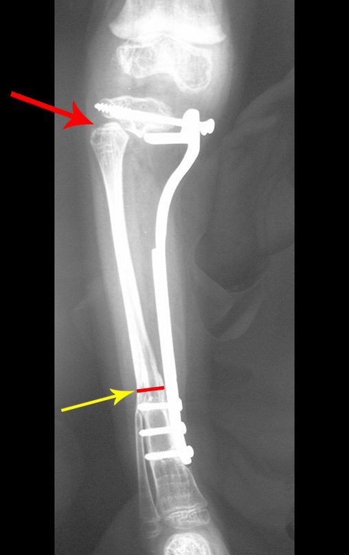 Figura 114: Radiografia pós operatório da perna direita, em 26/09/2007, frente, a seta vermelha assinala o aspecto da cabeça fibular. A seta amarela destaca o alargamento da diáfise da fíbula, devido ao espeçamento fibular.