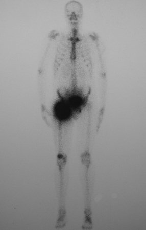 Figura 6: Cintilografia óssea com hiper captação acentuada da pelve direita e terço proximal do fêmur.