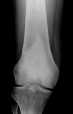 Figura 3: Radiografia do pós-operatório de curetagem intralesional indevida. Nesta radiografia já se pode observar áreas de rarefação ao redor de todo o cimento, indicando a presença de tumor.