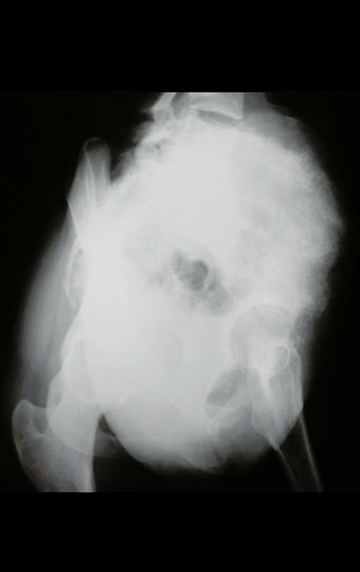 Figura 4: Radiografia da bacia em obturatriz, tumor obliterando o forame.