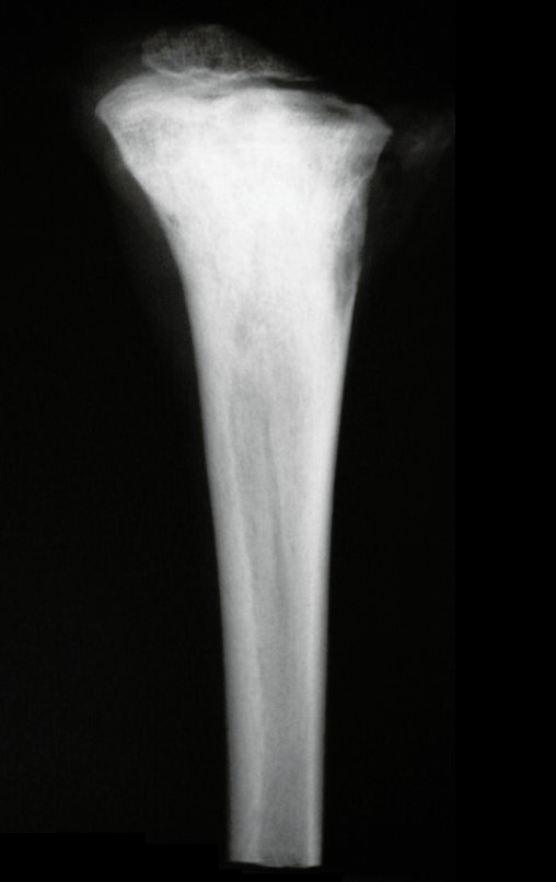 Figura 107: Radiografia do pós operatório da peça ressecada, frente.