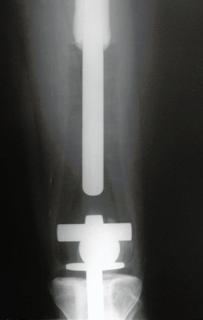 Figura 12: Radiografia de controle, frente, após vinte meses.