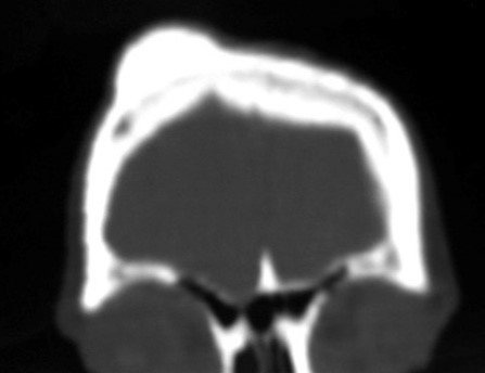 Figura 7 Tomografia coronal mostrando que a lesão atinge apenas a cortical externa.