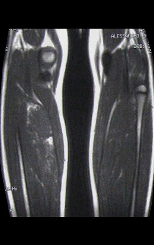 Figura 7: Rm coronal T1, onde se visualiza sinal elevado no ventre muscular medial do músculo sóleo.