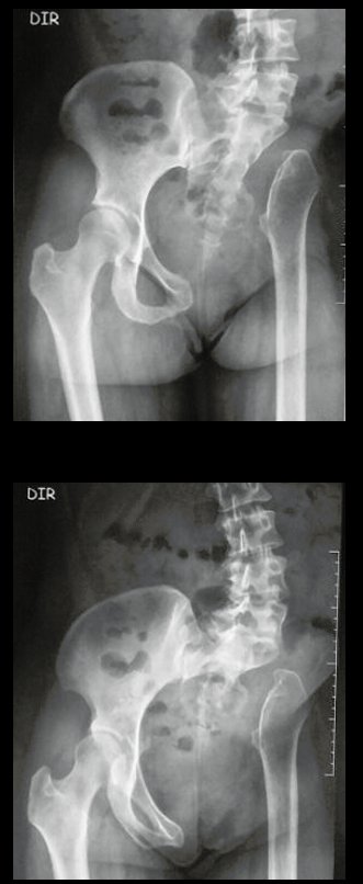 Figura 91: Radiografias da bacia, mostrando a pelvectomia interna à esquerda, em 12/05/2015.