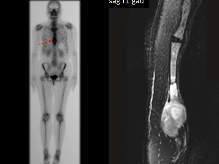 Metástasis de Sarcoma en el Esternón