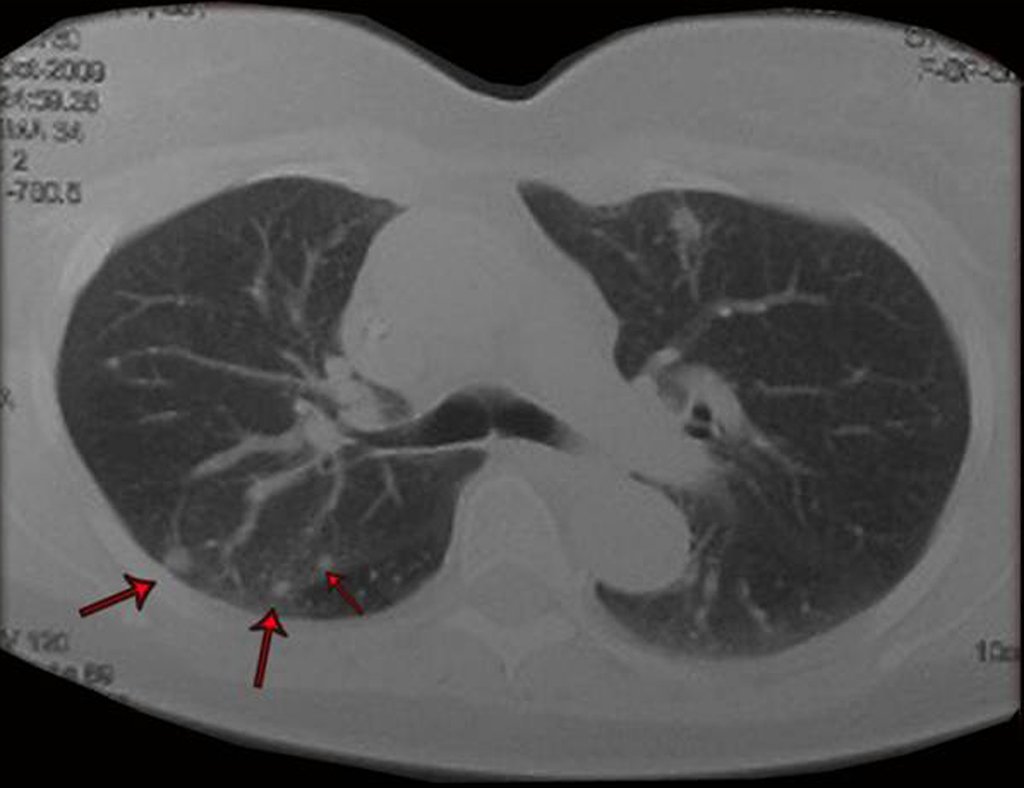 Figura 50: Tomografia do tórax, múltiplas metástases nos ápices pulmonares.