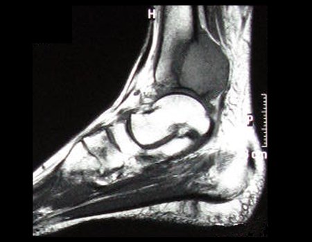 Figura 4: Rm sag T1. observamos grande lesão tumoral na região meta epifisária posterior da tíbia, de limites não precisos, rompendo totalmente a cortical posterior, crescendo em direção aos tecidos moles, com aparente preservação da superfície articular com o tálus.