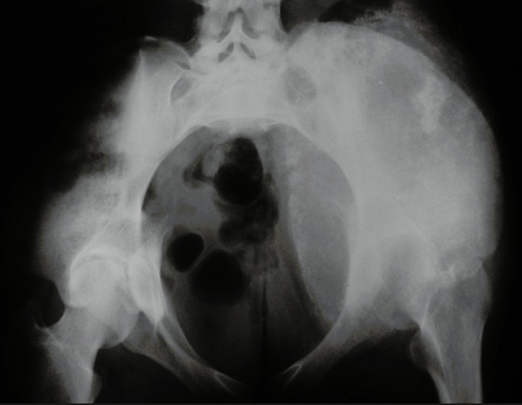 Figura 2: Radiografia da bacia in let, evidenciando inúmeros focos de calcificação.