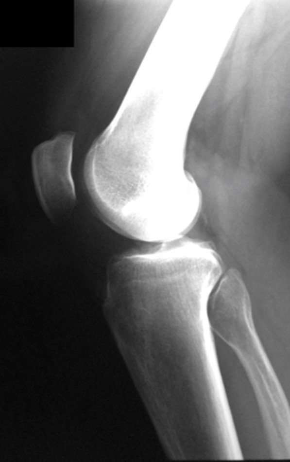 Figura 7: Radiografia do joelho direito de perfil, evidenciando sequela antiga de Doença de Os Good Schlatter, sem outras alterações relevantes ósseas ou de tecidos moles.