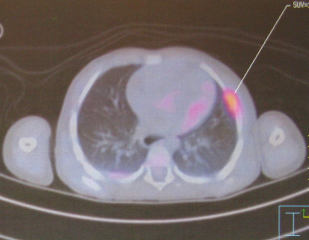 Figura 7: PET-CT assinalando lesão secundária no tórax.