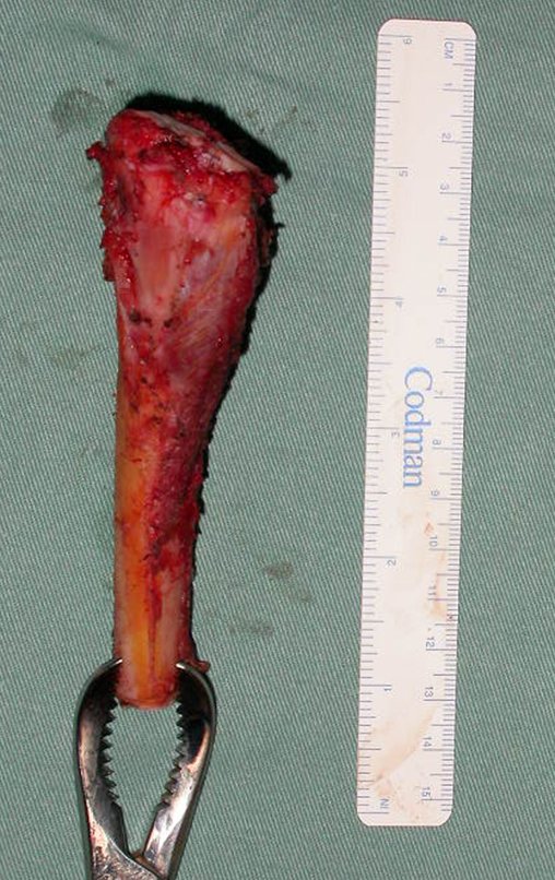 Figura 103: Peça ressecada, face medial.