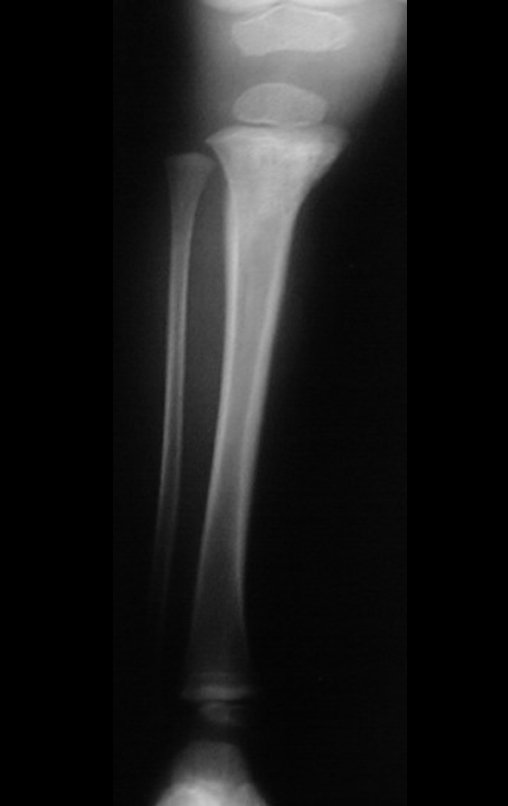 Figura 1: Radiografia da perna direita frente, com alteração na região metafisária proximal da tibia