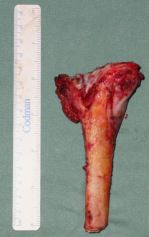 Figura 100: Peça ressecada, com o trajeto da biópsia, osteotomia curvelínea proximal, transfisária e parte transepifisária, face anterior.